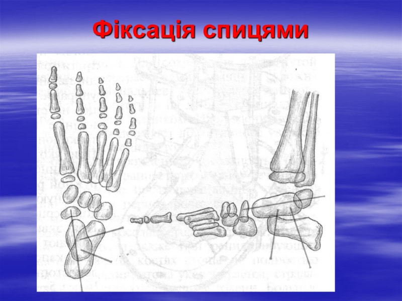 Фіксація спицями